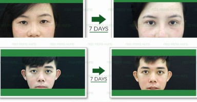 Cắt mắt 2 mí giúp đôi mắt to tròn hơn