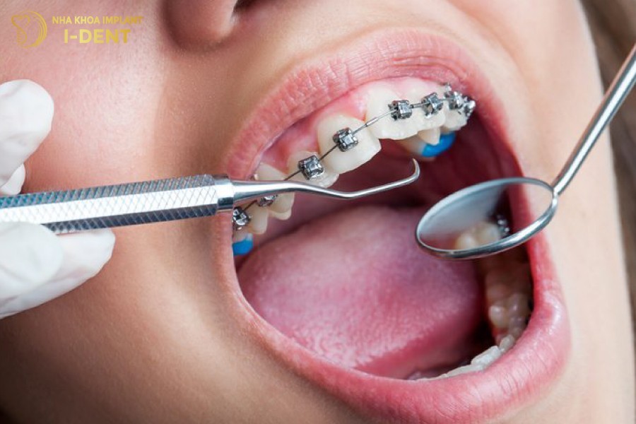Bác sĩ tay nghề cao sẽ giúp quá trình niềng răng diễn ra nhanh chóng