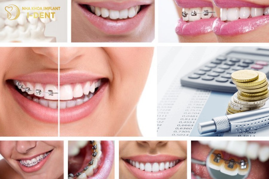 Giá niềng răng tại mỗi nha khoa sẽ khác nhau