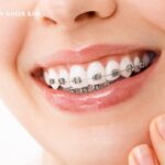 niềng răng mắc cài kim loại