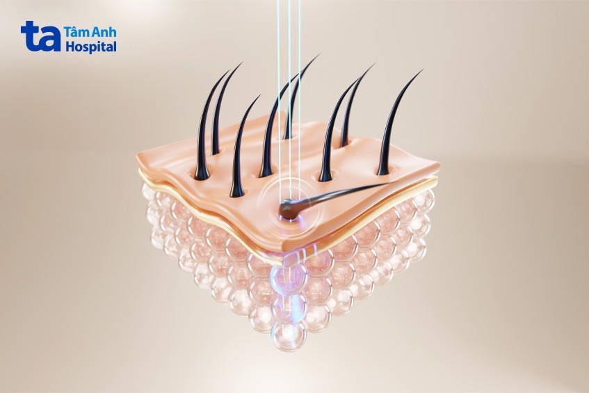 lợi ích khi lựa chọn triệt lông vĩnh viễn