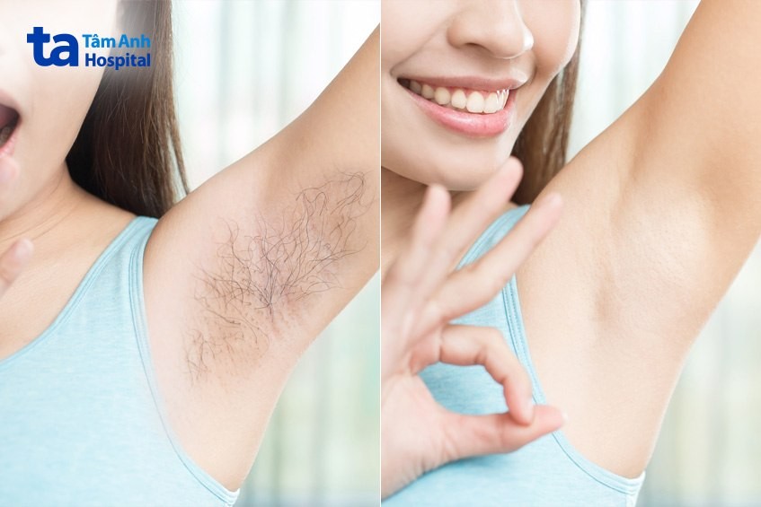 lưu ý khi lựa chọn triệt lông