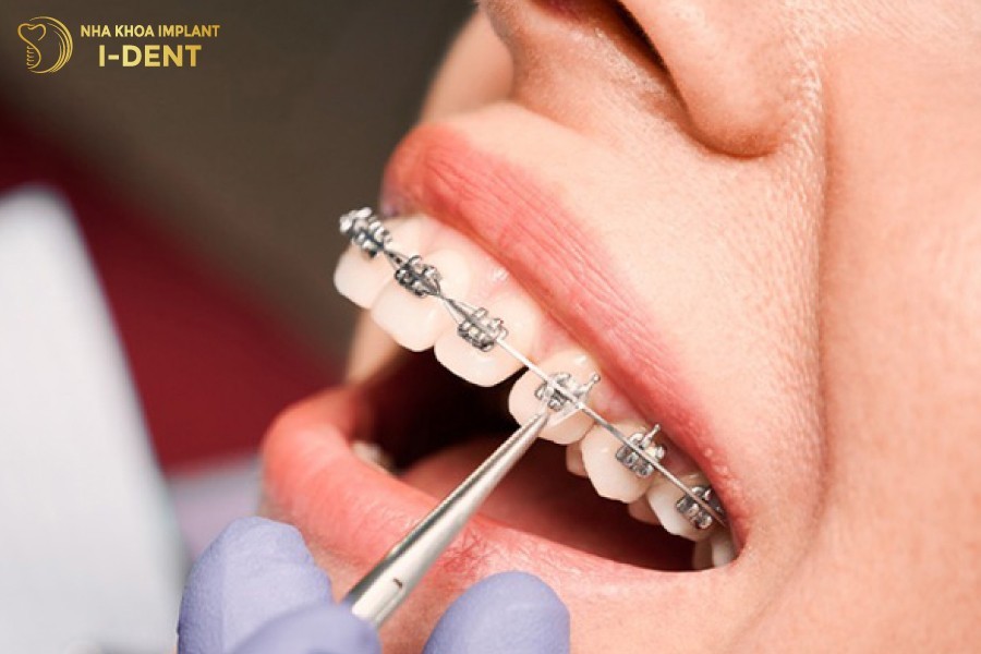 Niềng răng 1 hàm đối với hàm trên bị hô nhẹ