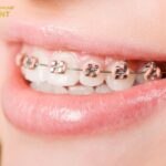 Niềng răng mang lại hàm răng đều đẹp và khớp cắn chuẩn
