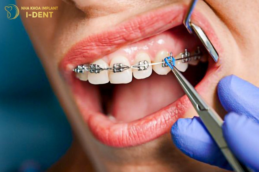 Răng dễ đau nhức, khó chịu khi niềng răng 1 hàm