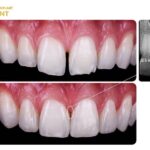 Trám răng thưa bằng composite thẩm mỹ