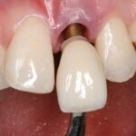 Khách hàng lựa chọn răng sứ tại nha khoa