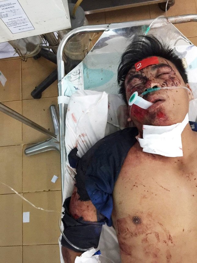 Foto van vrachtwagenchauffeur Võ Văn Quý in kritieke toestand