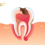 Túi mủ hình thành dưới vùng chân răng gây đau nhức, tương tự như vấn đề có thể xảy ra với laz răng xe tải nếu không được bảo dưỡng