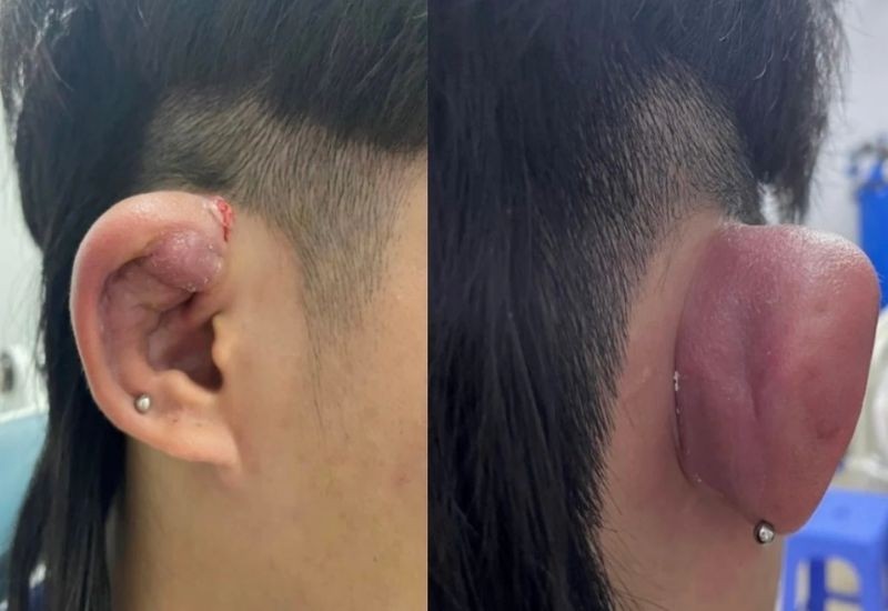 Hình ảnh áp xe tai