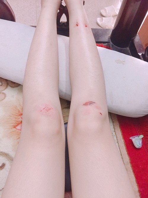Băng bó vết thương ở chân sau tai nạn xe máy