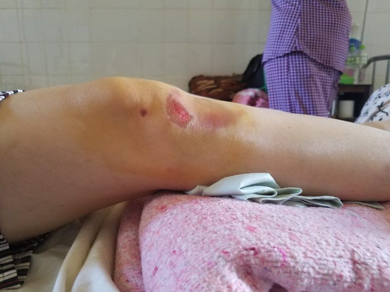 Chân bị sưng và bầm tím sau té xe máy