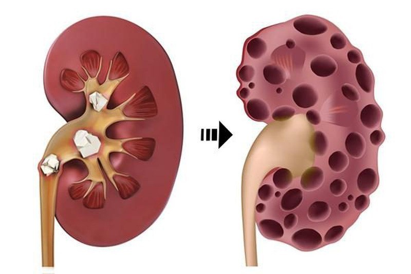 Suy tháº­n lÃ  bá»‡nh nguy hiá»ƒm gÃ¢y biáº¿n chá»©ng náº·ng náº¿u can thiá»‡p cháº­m trá»…