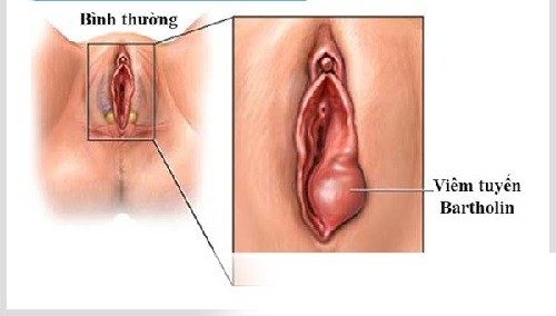 Viêm tuyến bartholin