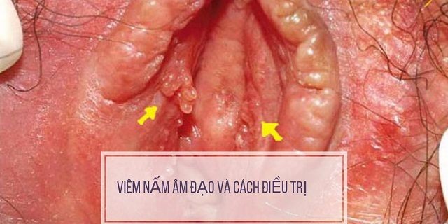 Hình ảnh nổi mụn âm đạo