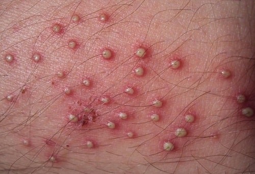 Hình ảnh mọc mụn ở vùng kín nữ