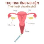 Hình ảnh minh họa quá trình chuyển phôi trong thụ tinh ống nghiệm với catheter
