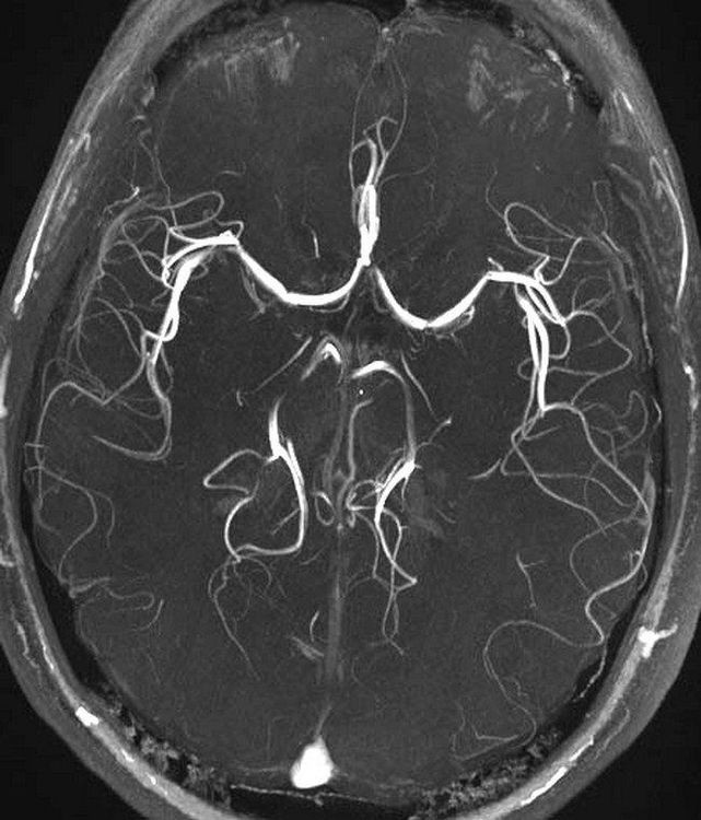 Chụp MRI não cho kết quả rõ ràng hơn chụp cắt lớp vi tính. Alt text: Hình ảnh chụp MRI não bộ, hiển thị rõ cấu trúc chất xám và chất trắng, hỗ trợ chẩn đoán các bệnh lý thần kinh tại Xe Tải Mỹ Đình.