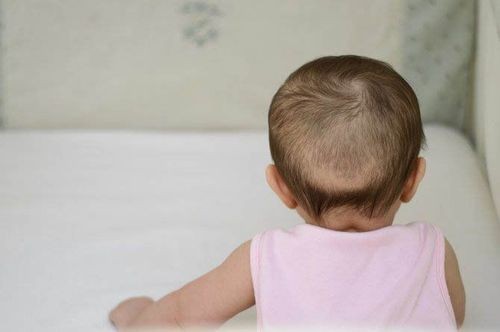 Rụng tóc vành khăn ở trẻ nhỏ