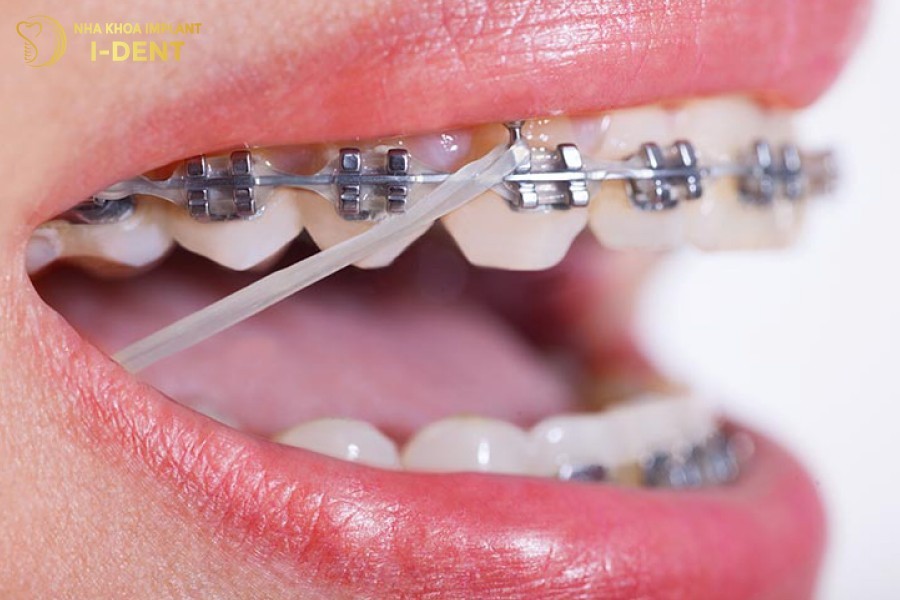 Sử dụng chun đóng khoảng kéo khoảng trống giữa các răng lại với nhau
