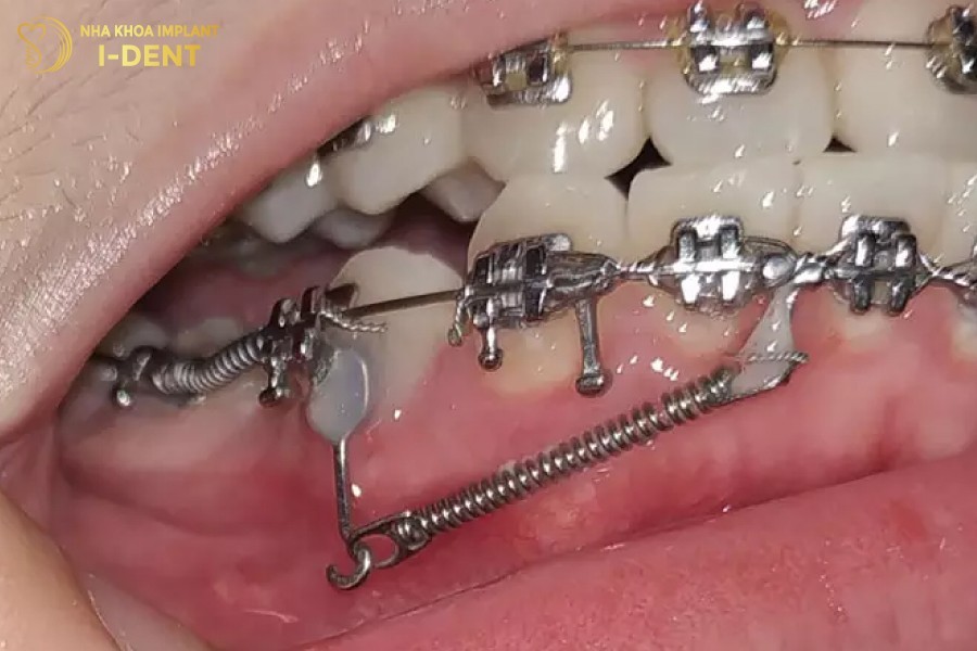 Sử dụng lò xo để đóng khoảng trong chỉnh nha