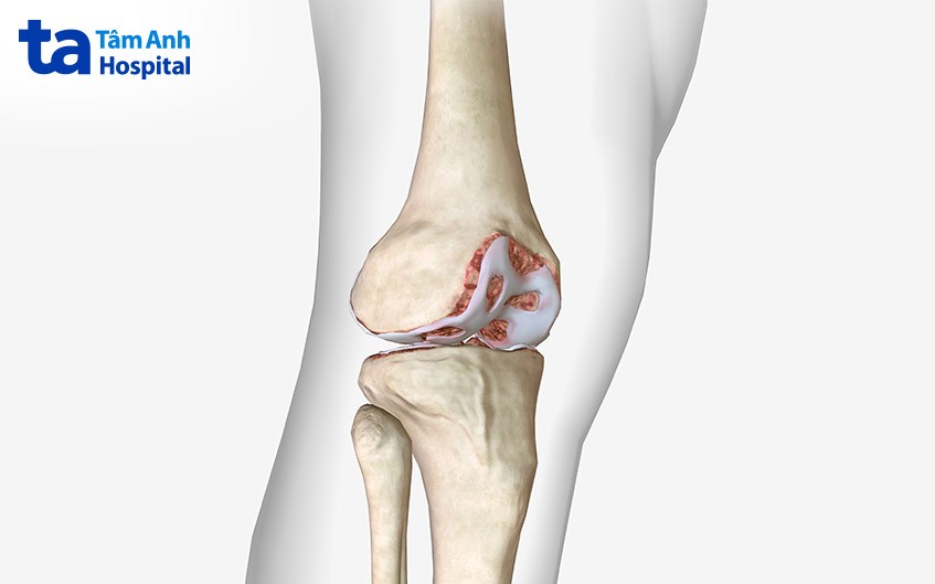 Sụn khớp là miếng đệm nối 2 đầu xương