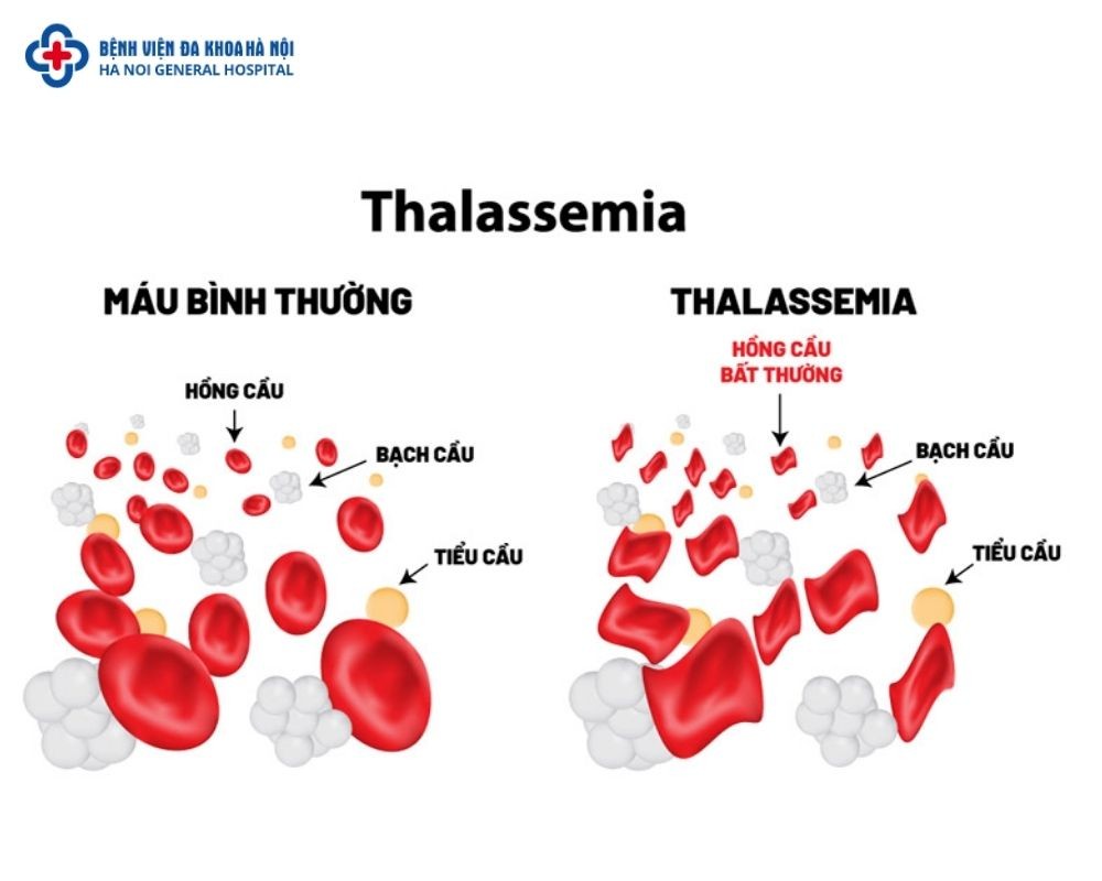 Äá»™t biáº¿n dá»‹ há»£p tá»« SEA cÃ³ thá»ƒ dáº«n Ä‘áº¿n bá»‡nh thalassemia