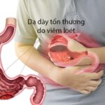 Viêm loét dạ dày là bệnh lý khá thường gặp ở người Việt