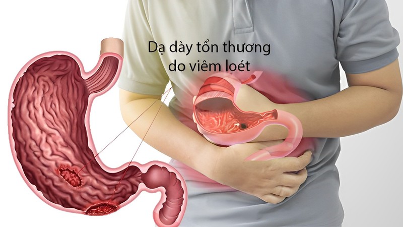 Viêm loét dạ dày là bệnh lý khá thường gặp ở người Việt