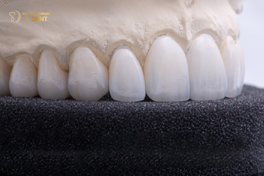 Răng sứ Cercon có độ hoàn thiện tốt, thẩm mỹ cao