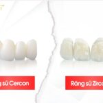 So sánh răng sứ Cercon và Zirconia để đưa ra lựa chọn tốt nhất