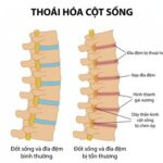 Thoái hóa là gì và các giai đoạn thoái hóa