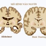 Người cao tuổi đang suy nghĩ, minh họa cho chứng lẩn thẩn