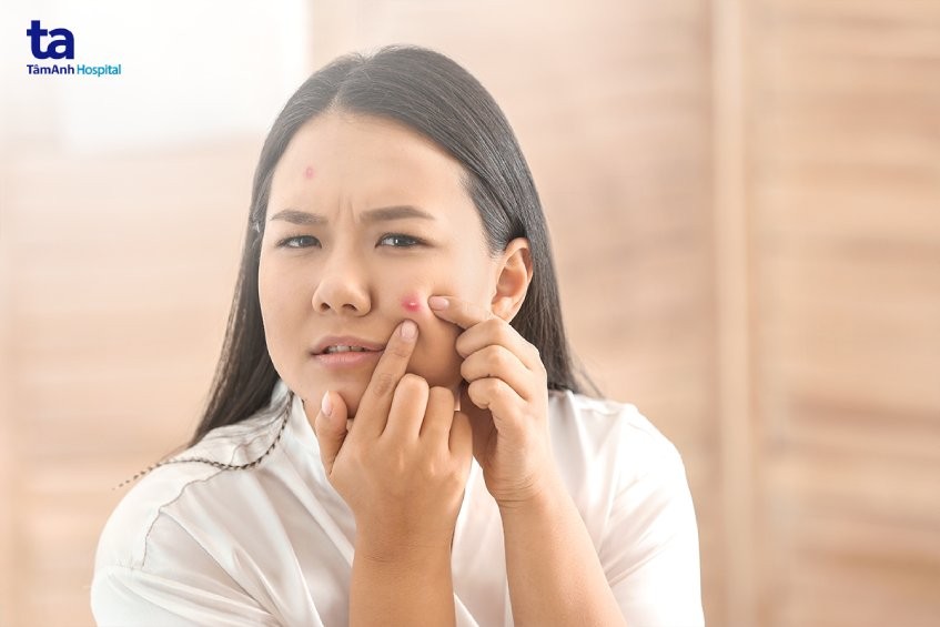 Ăn nhiều đường dễ nổi mụn trứng cá