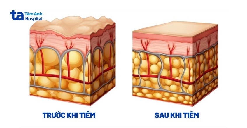 so sánh trước và sau khi tiêm filler