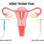 vòng tránh thai nội tiết