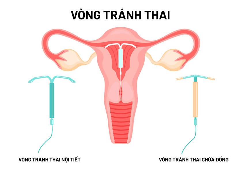 vòng tránh thai nội tiết