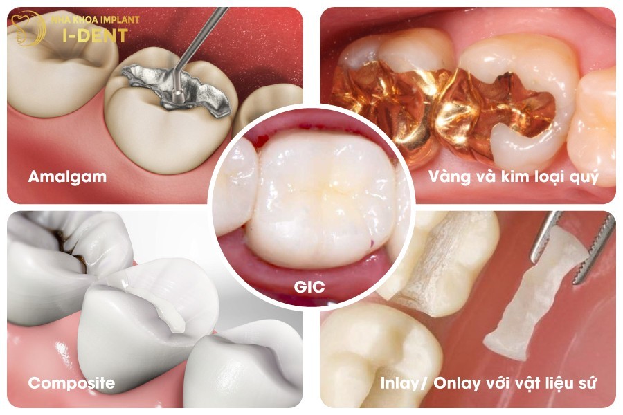 Các loại vật liệu trám răng phổ biến