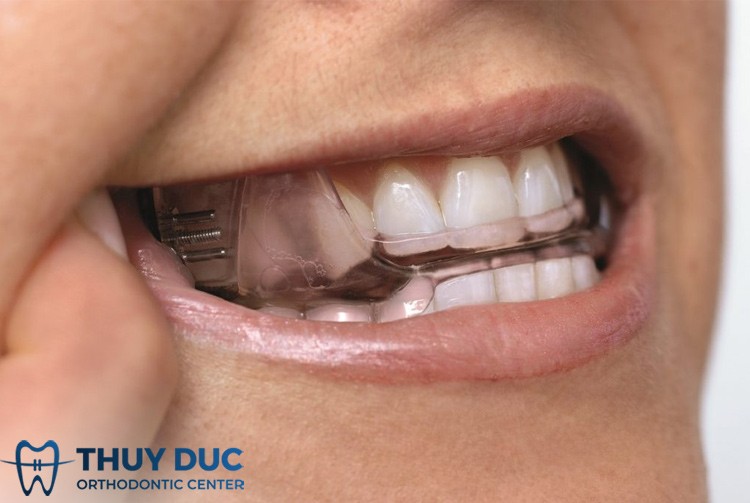 Chú Ý Khi Chọn Dùng Miếng Chống Nghiến Răng