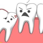 Thời điểm thích hợp nhổ răng khôn