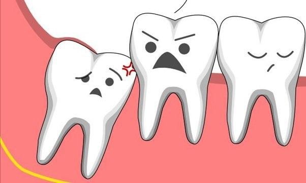 Thời điểm thích hợp nhổ răng khôn