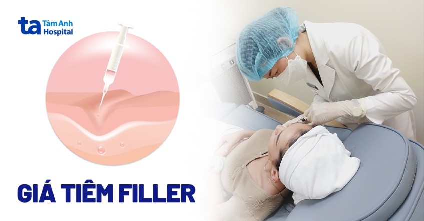 tiêm filler là gì