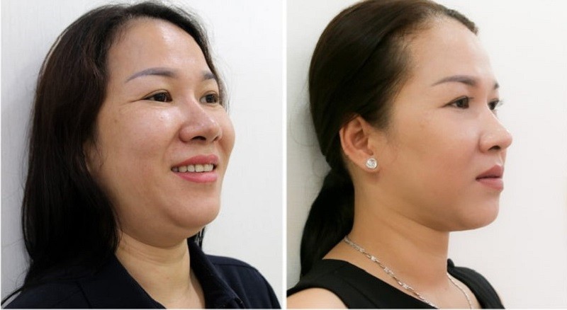 Trường hợp nhiều mỡ nọng cằm cần hút mỡ mới có hiệu quả đáng kể