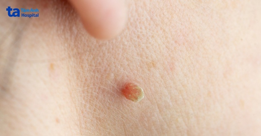Hình ảnh mụn thịt phát triển trên cổ