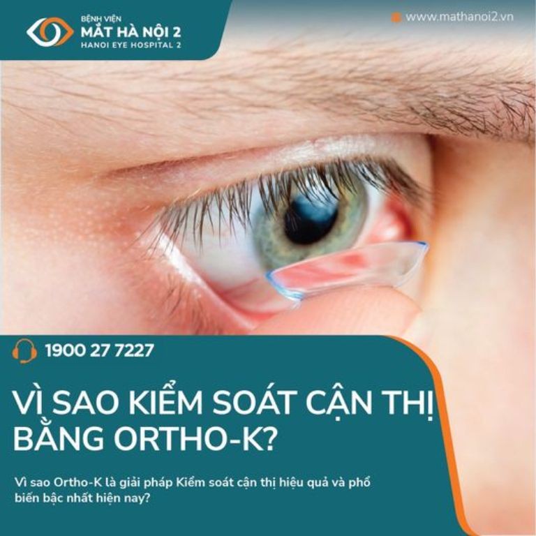 Lens cứng Ortho-K