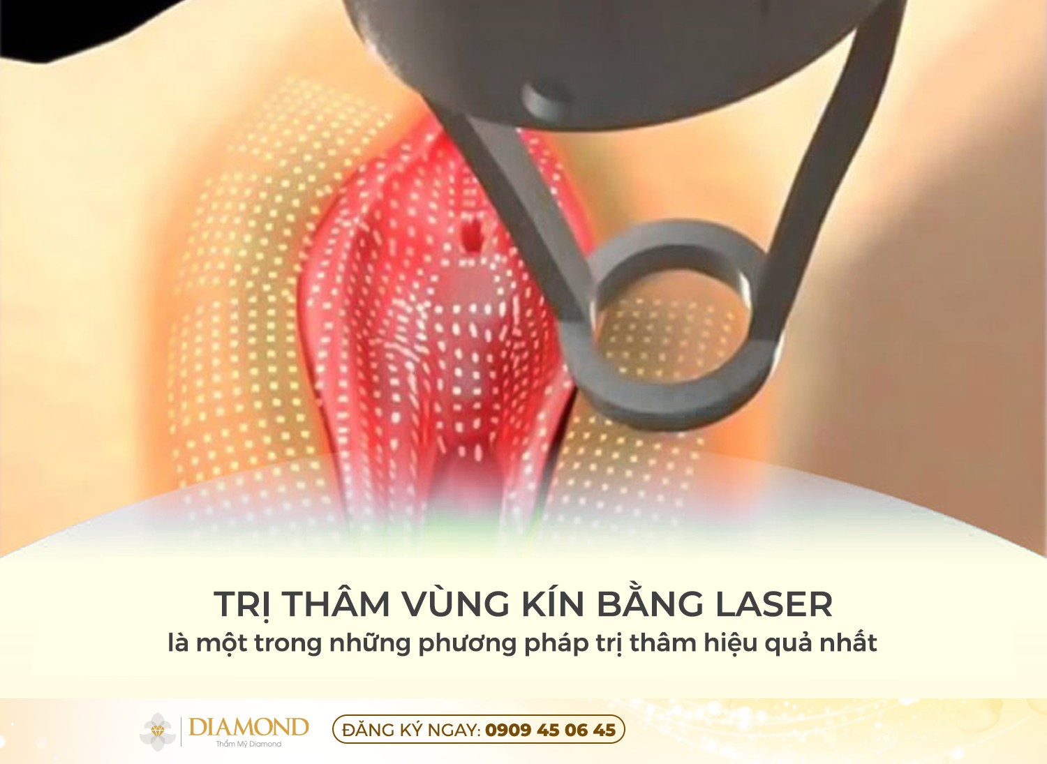 Các bước làm hồng vùng kín bằng laser