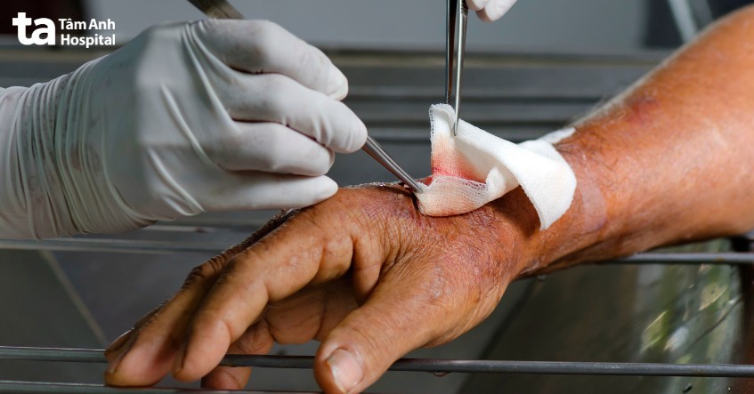 Hình ảnh lưu ý khi điều trị mụn thịt