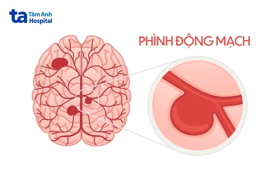 mo ta benh phinh dong mach mau nao