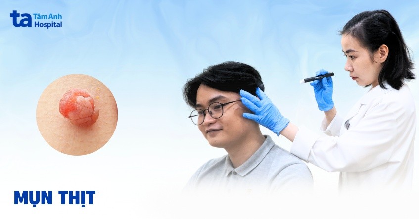 Hình ảnh mụn thịt