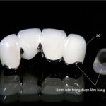 Cấu tạo răng sứ Titan